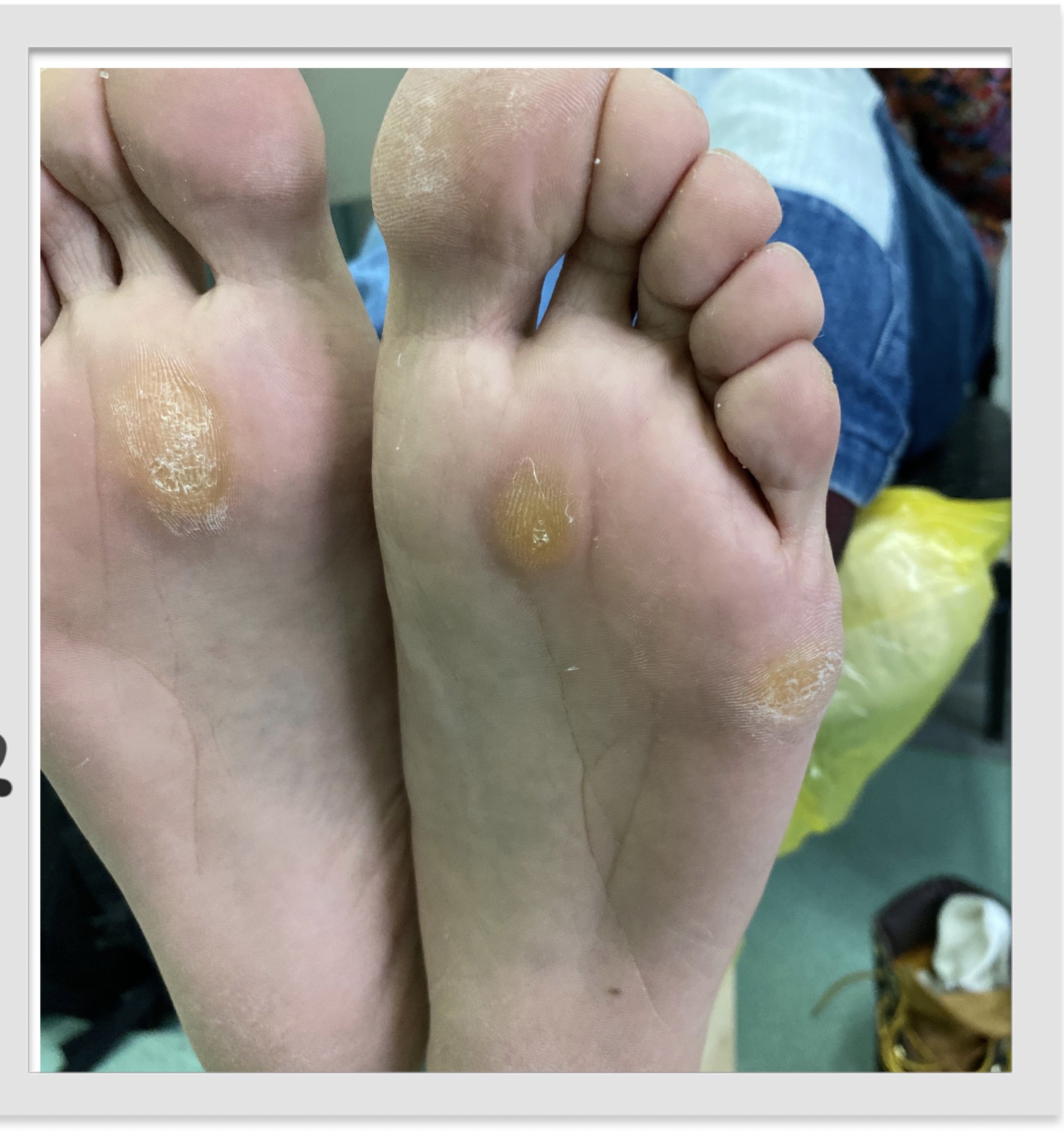胼胝哪家医院看的好,治疗胼胝哪个医生好,胼胝推荐_好