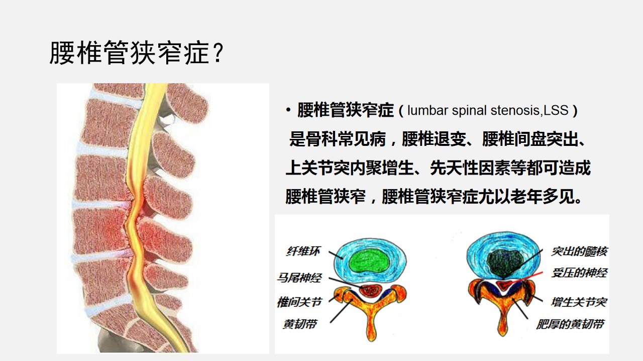 脊柱内镜椎间孔镜治疗腰椎管狭窄症