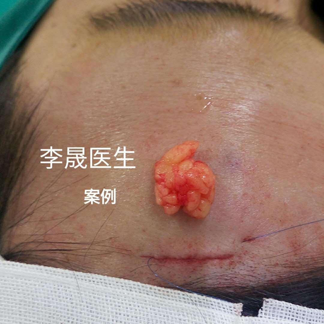 额部脂肪瘤微创无痕切除