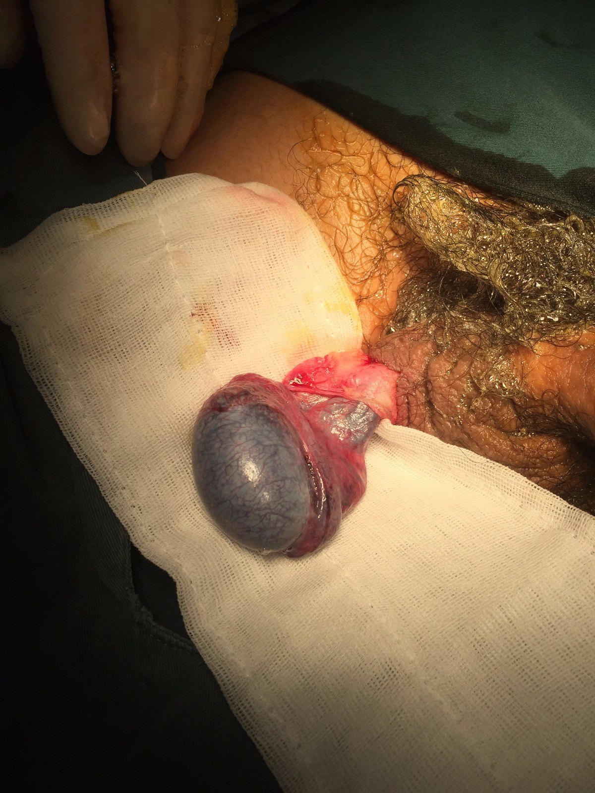 「蛋蛋」红肿疼痛,不要在家耽搁 这是一例"睾丸扭转"的病例:15岁少年