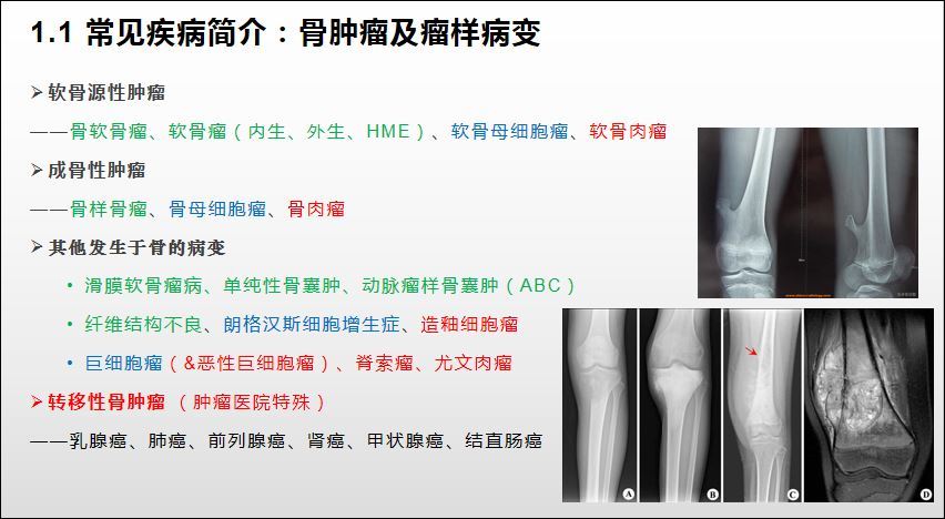 常见的骨肿瘤有哪些?