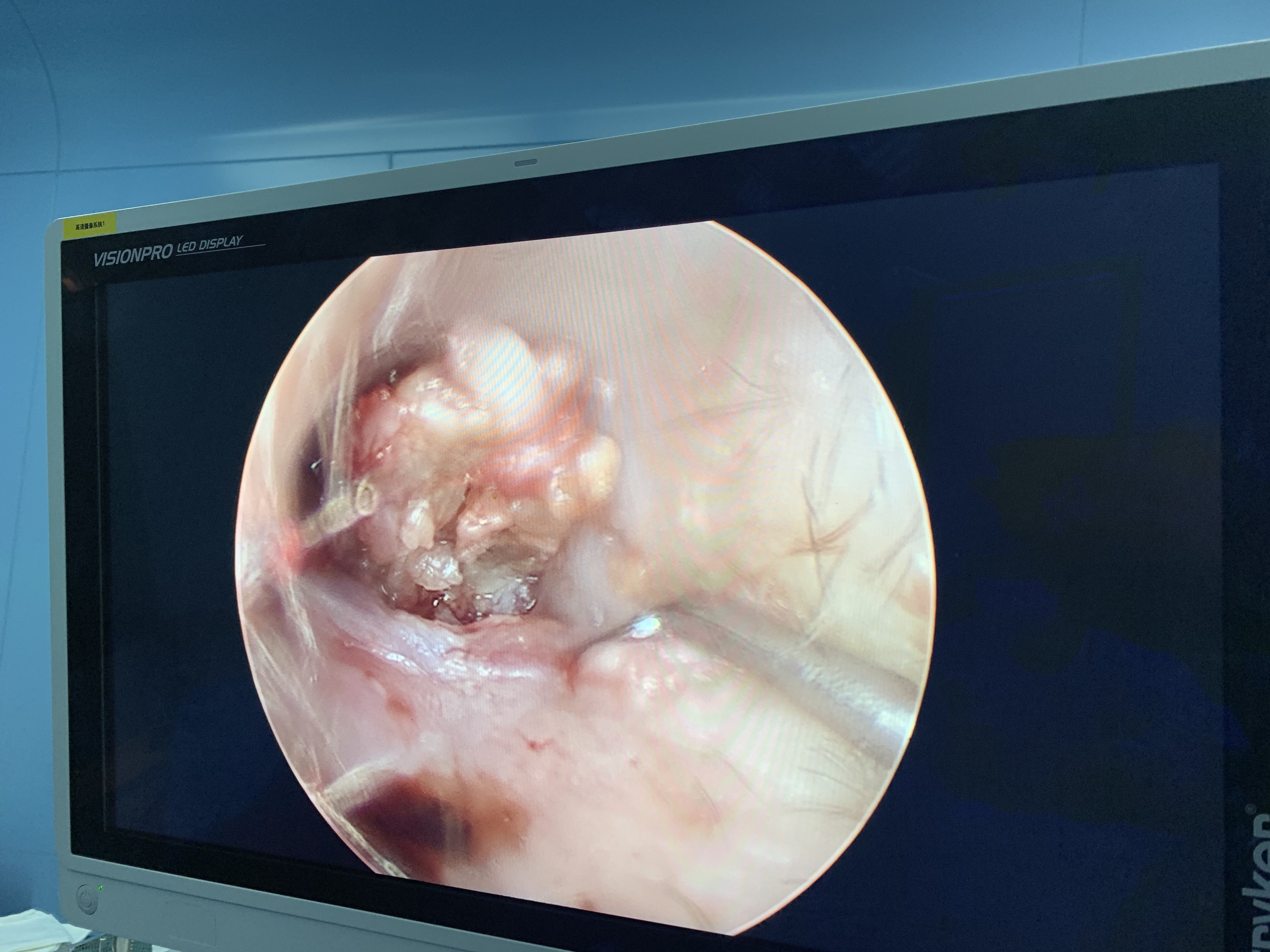 耳内镜下外耳道胆脂瘤清除术(更新)