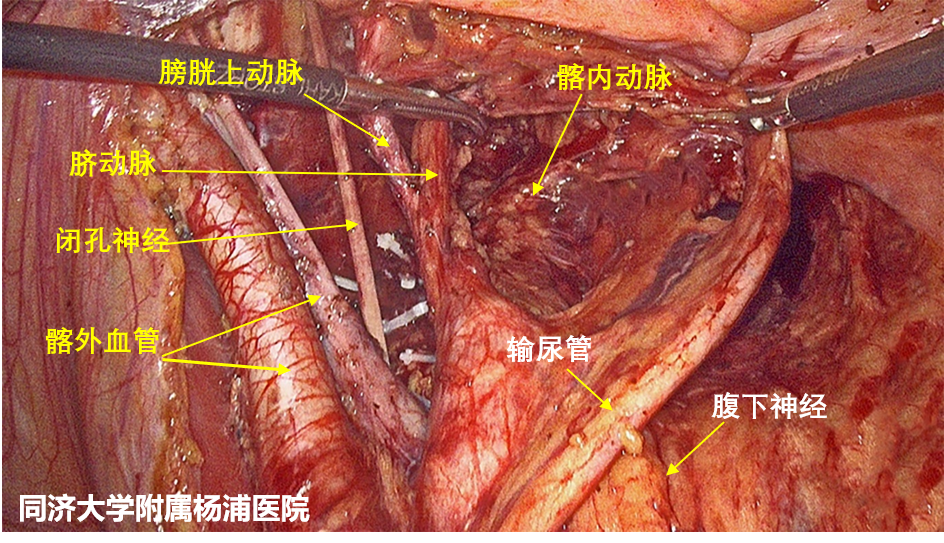 上图:该患者术前盆腔磁共振检查,提示左侧盆腔淋巴结肿大 pet-ct(治疗