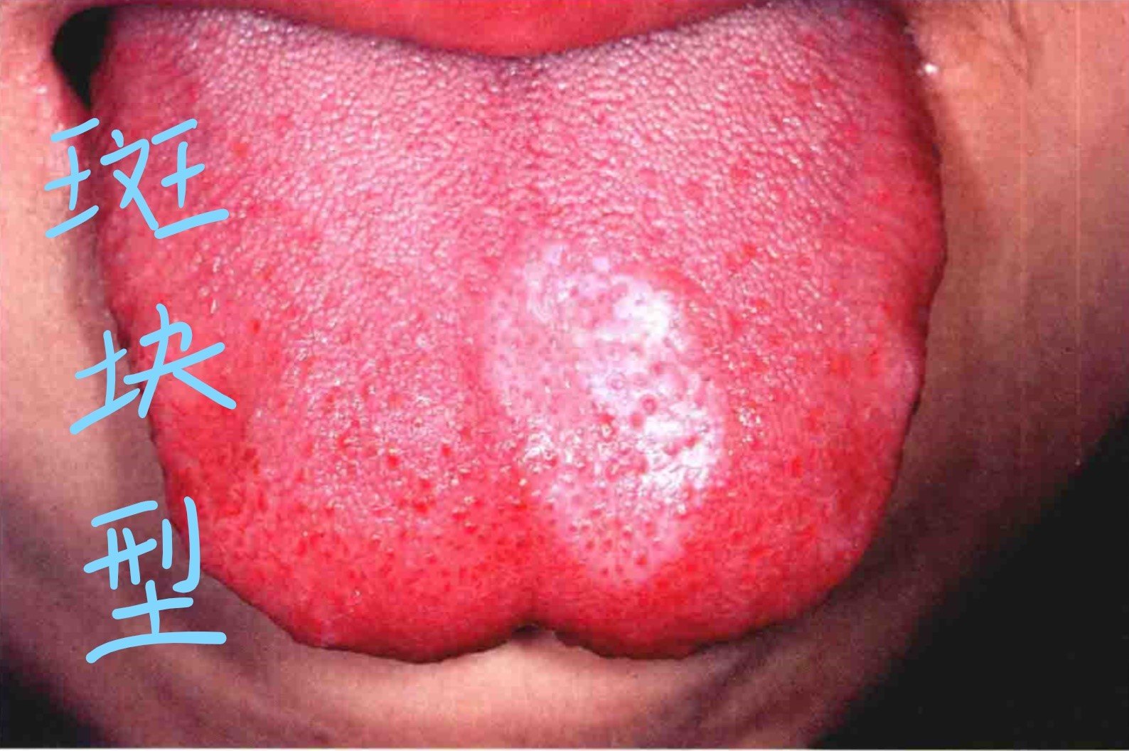 口腔黏膜白色扁平苔藓的图文介绍
