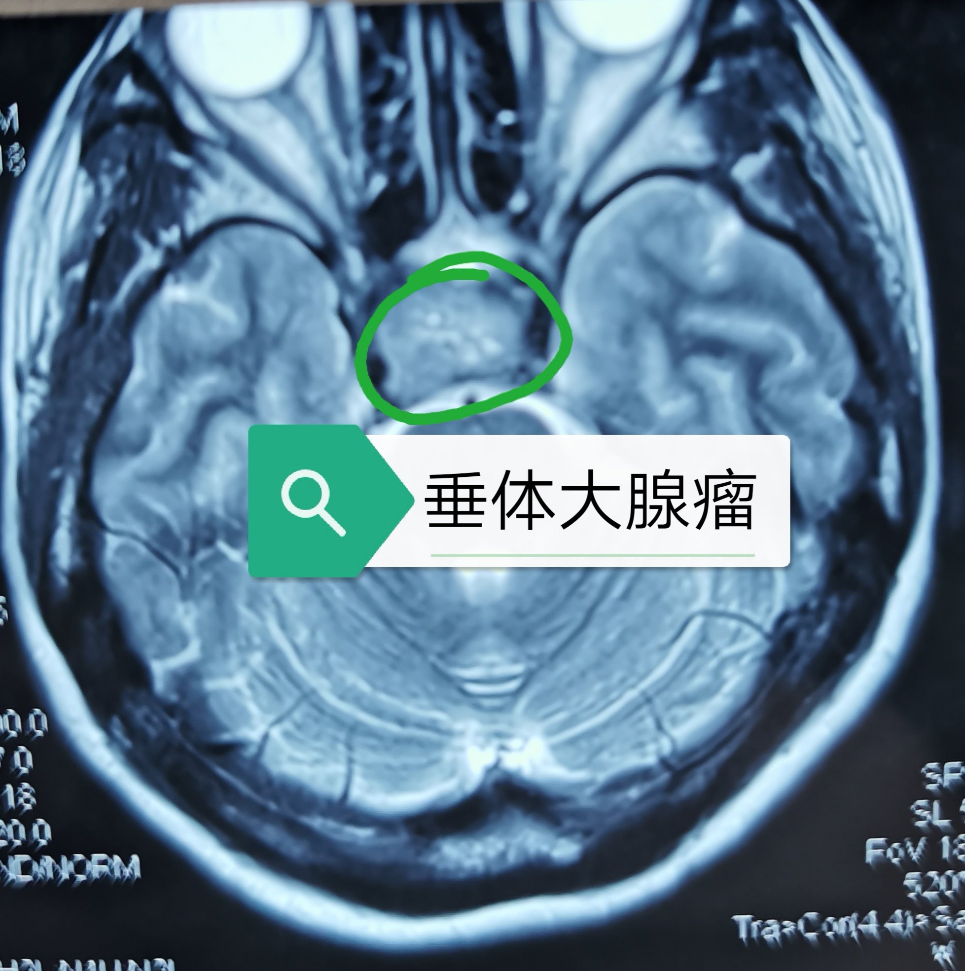 好大夫在线 张学军 神经内镜下顺利切除二台侵袭性垂体大腺瘤  术后ct