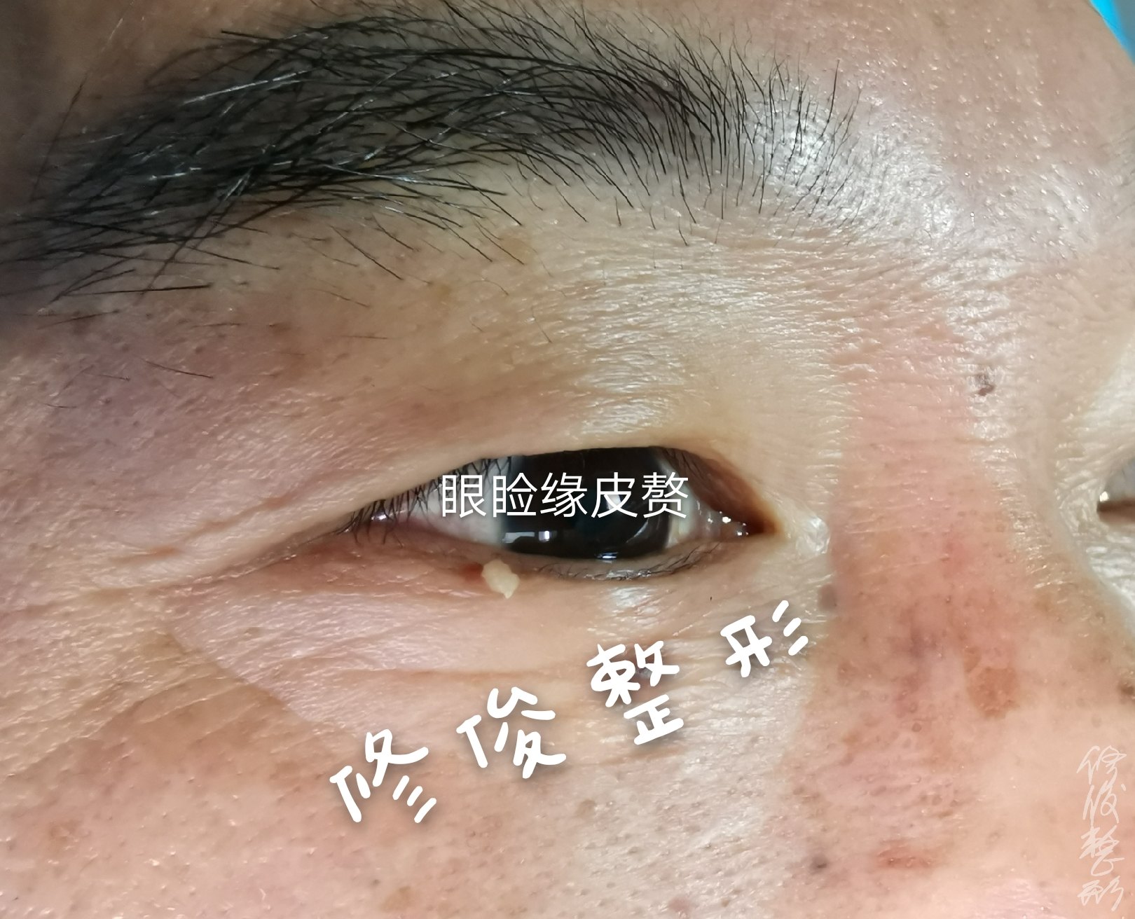 眼睑皮赘毛细血管痣一般表面红色,稍突出于皮肤,按压可以褪色,对身体