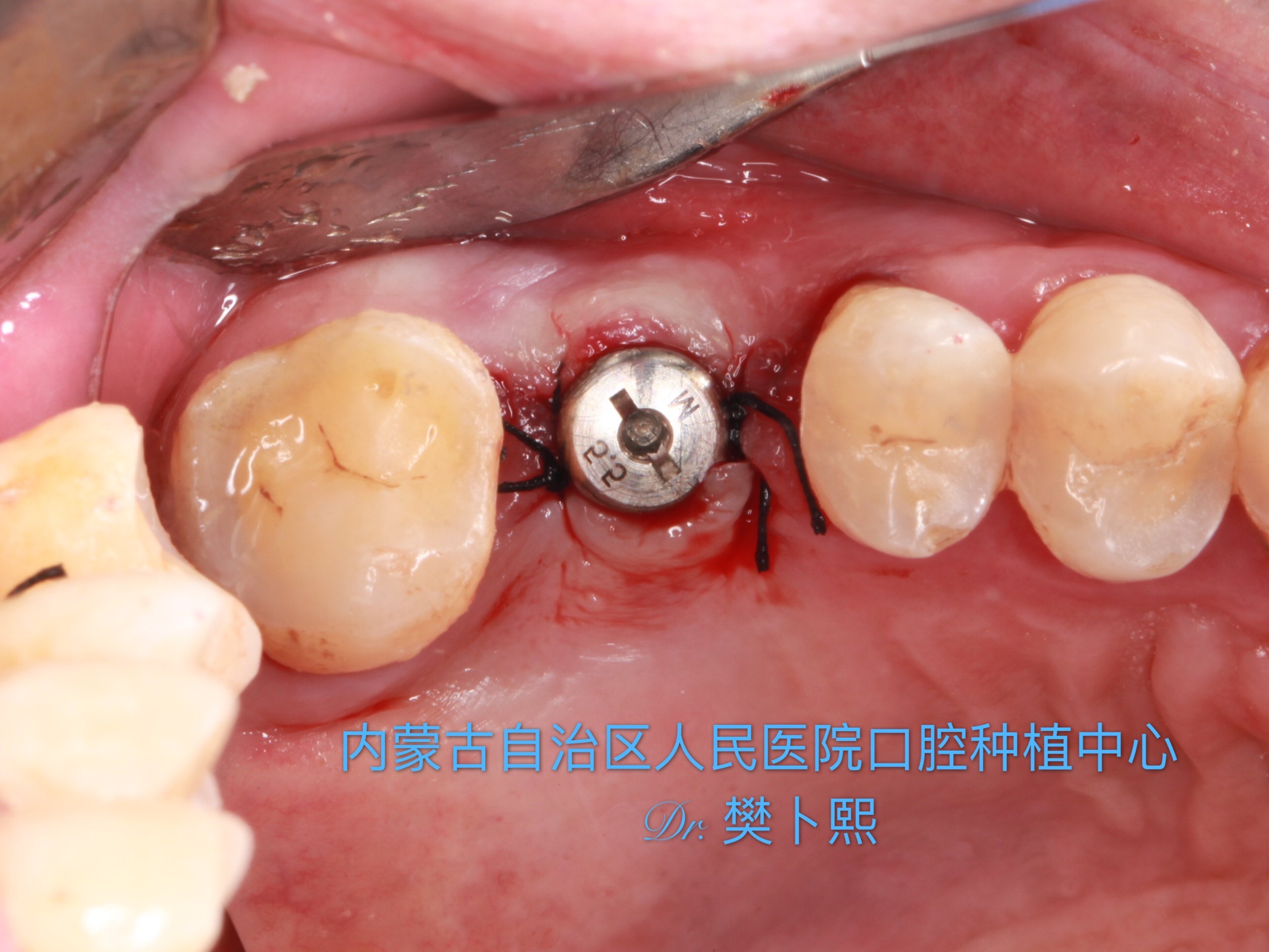 种植ii期手术术后注意事项_牙齿种植 - 好大夫在线