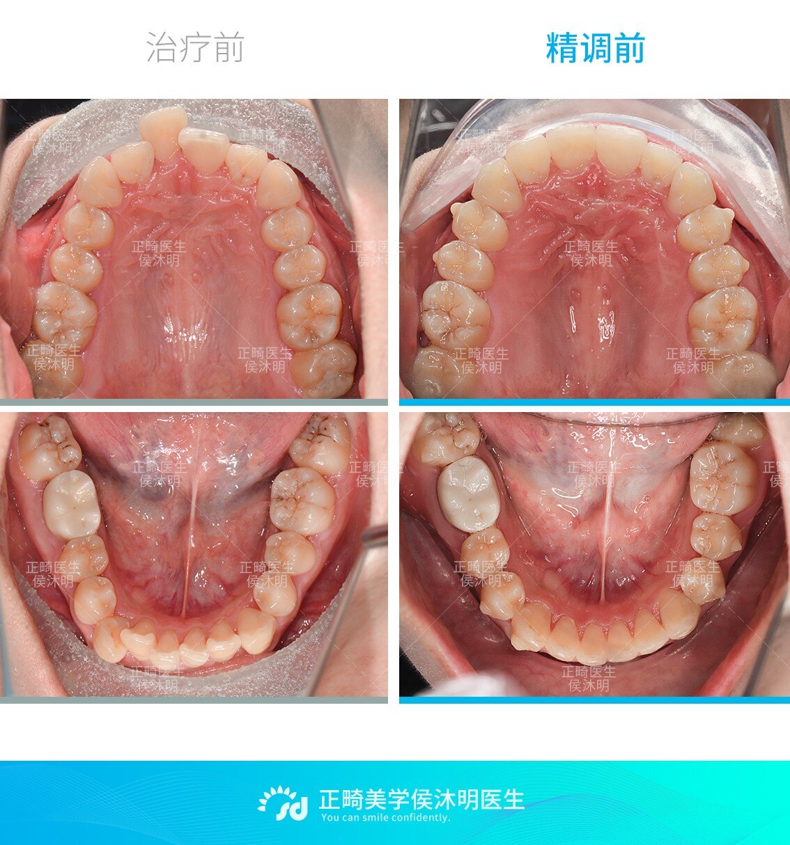 中度牙齿拥挤非拔牙隐形矫正案例