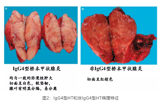 桥本甲状腺炎的新认识