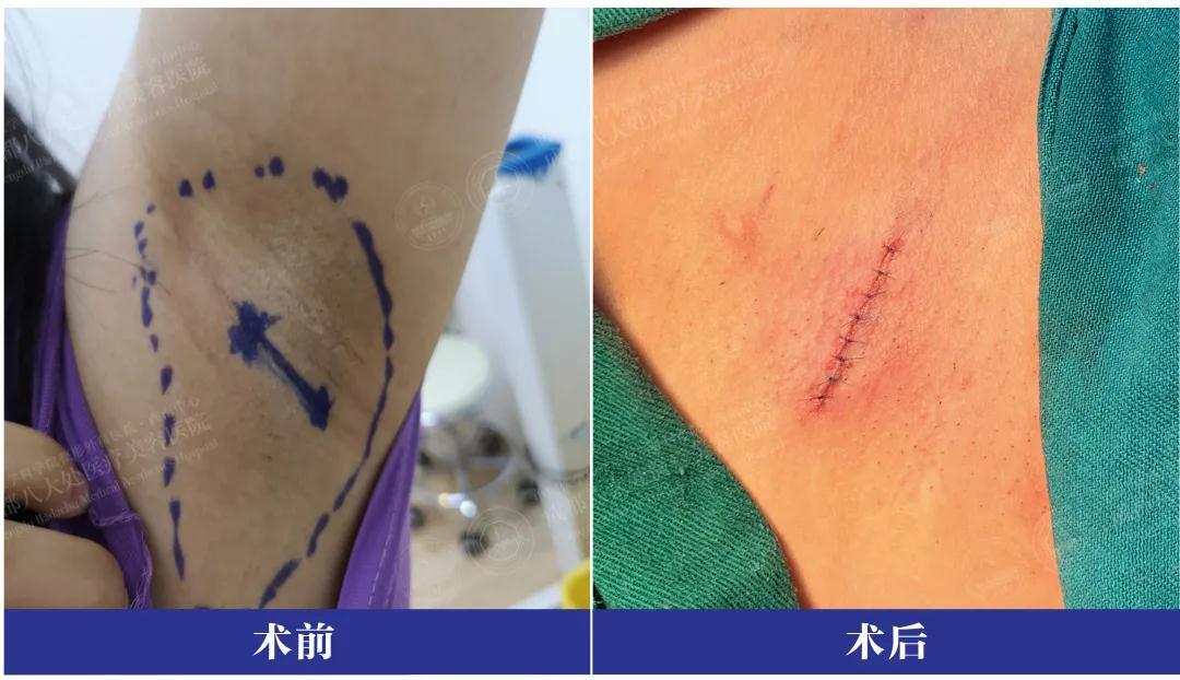 注射 微创手术除腋臭!帮你解决体臭尴尬