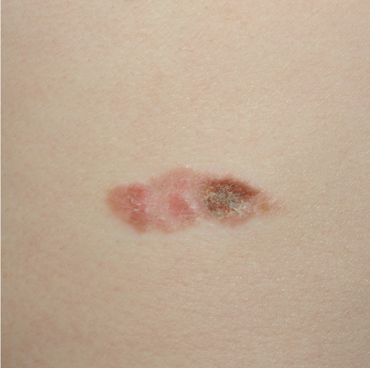 皮肤上持续不消退的小斑块,需要警惕鲍温病——一种癌