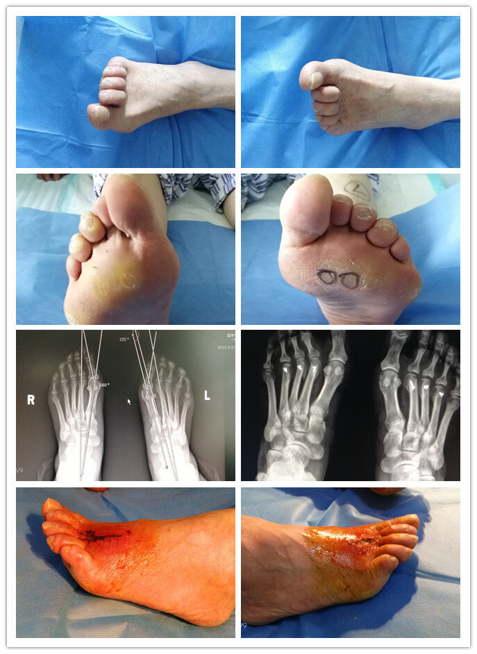 术后随访双足踇外翻仰趾伴锤状趾畸形