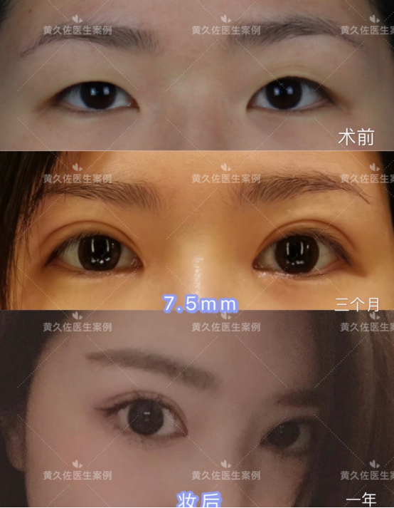 宽度怎么选?_双眼皮手术 好大夫在线