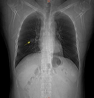 ct定位片(相当于胸片)可见右侧肺门处占位