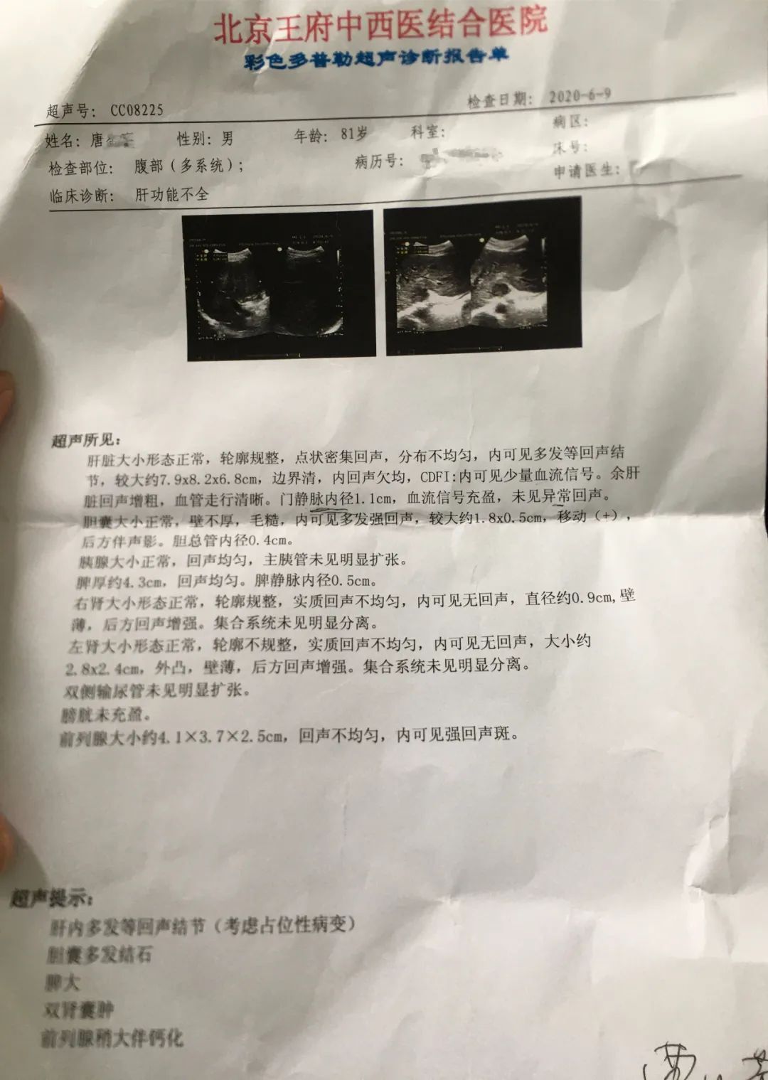 东直门医院 李蕴铷 病例分享—肝癌患者好转实例 诊断结果:肝癌 彩超