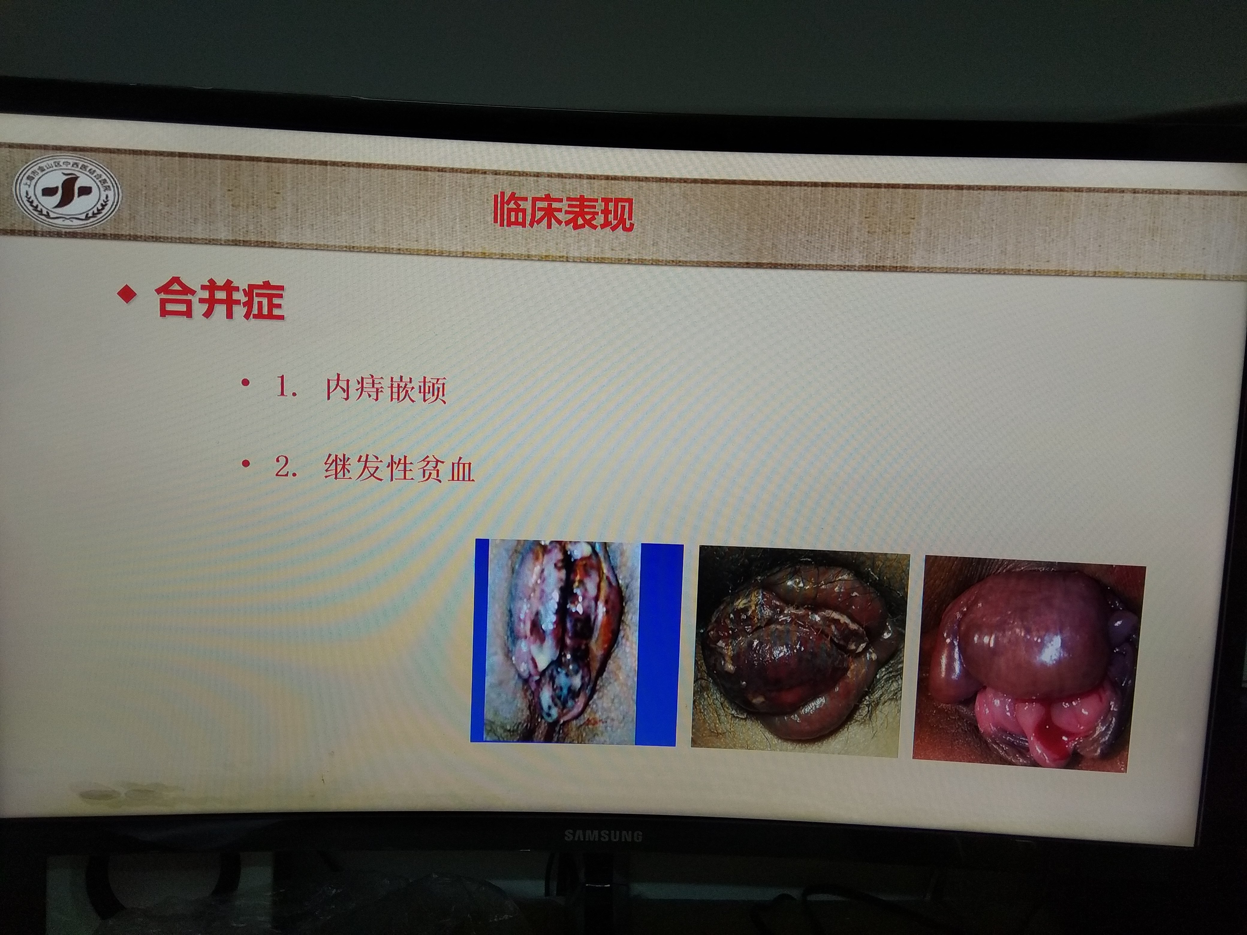 带你认识内痔,外痔及混合痔的临床表现_痔疮 - 好大夫