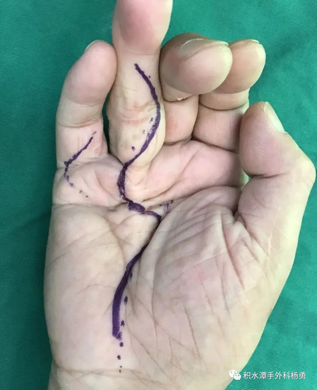 环指,小指掌腱膜挛缩 q:做这个手术有什么风险吗?
