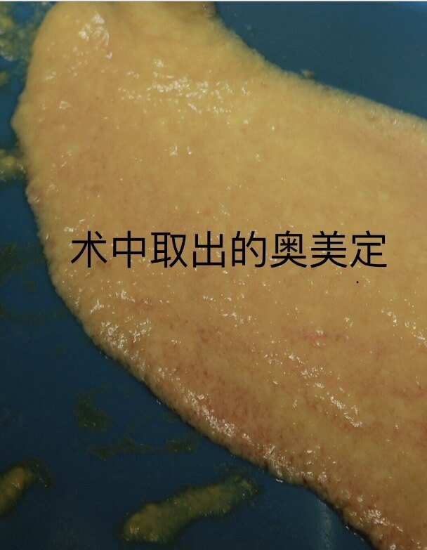 奥美定的危害乳房奥美定取出一例