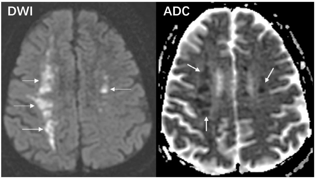 由于dwi和adc序列的异常信号极其符合急性脑梗死的影像学表现,最终