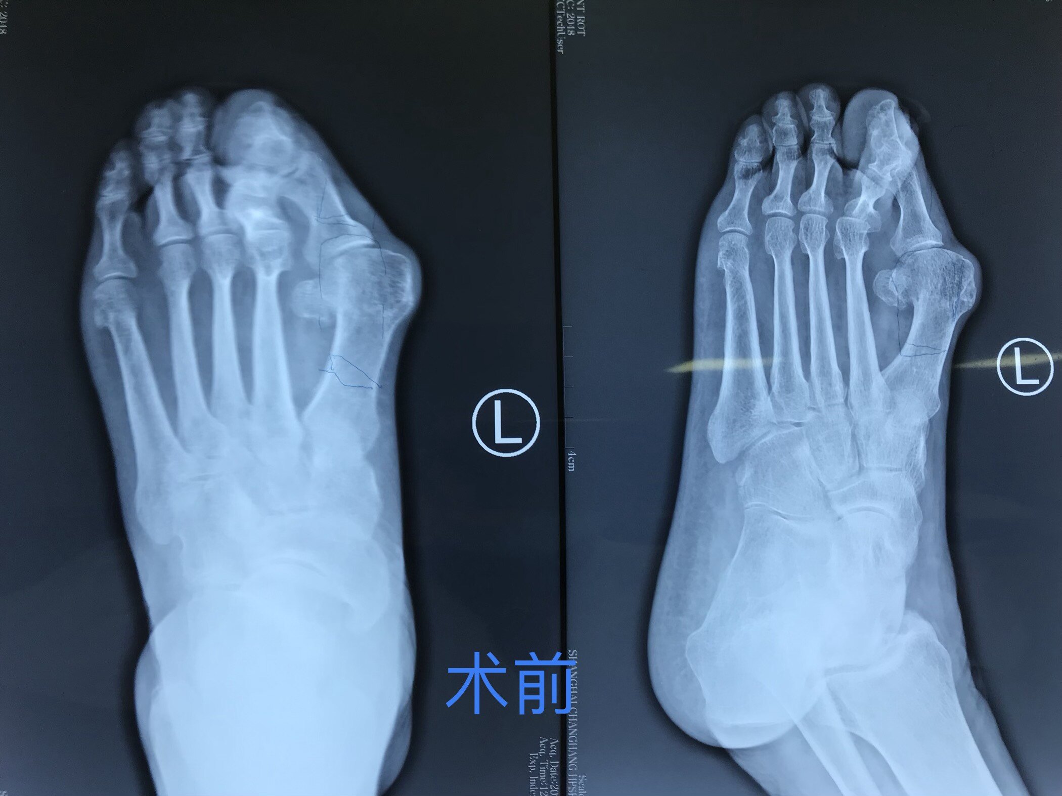 术前X线片显示拇指及第2趾跖趾关节半脱位改变拇指外翻畸形术后改变
