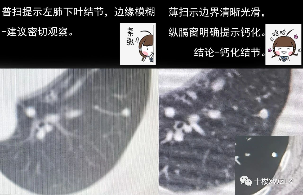话说肺小结节之普扫胶片与薄层ct_肺部结节 - 好大夫