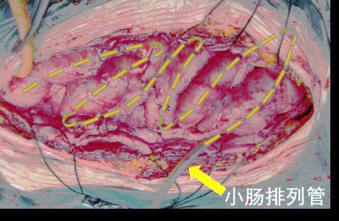 肠梗阻小肠排列手术技术介绍