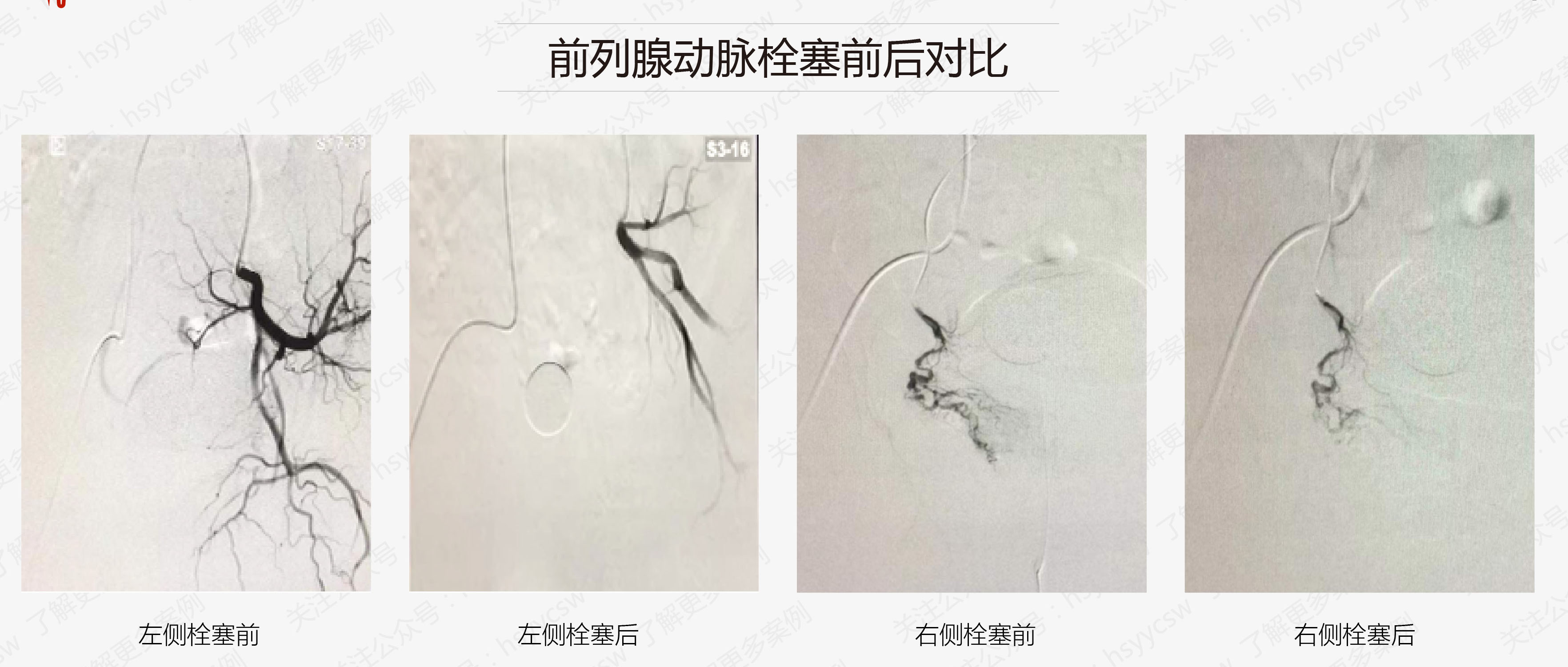 前列腺动脉栓塞术将病灶釜底抽薪守护男性生命腺