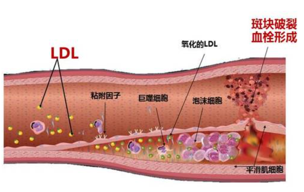 谈斑色变,动脉粥样硬化斑块你知道多少