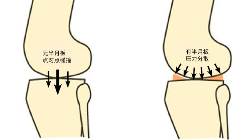 > 膝关节半月板损伤常见问题解读 半月板弹性好,可以分散并吸收膝盖