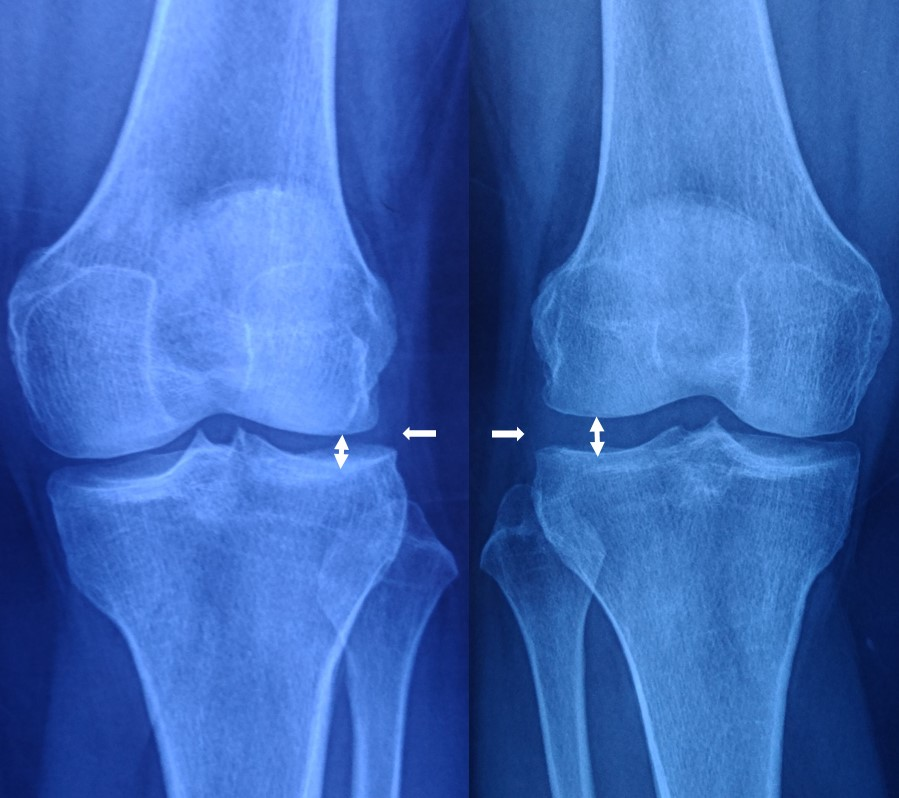图31. 患膝(左图)关节间隙稍变窄,未见明显骨赘增生,为1-2度退变.