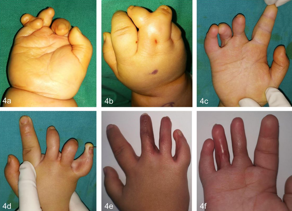 先天性并指畸形科普以及案例分享