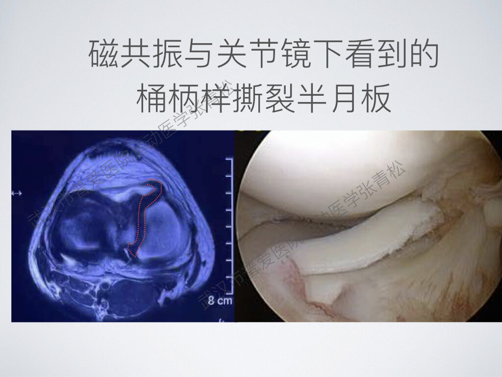 桶柄样半月板撕裂,是什么样的_膝关节半月板损伤_膝板