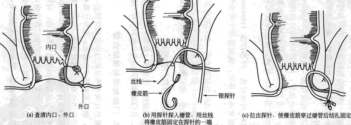 什么是肛瘘挂线术?