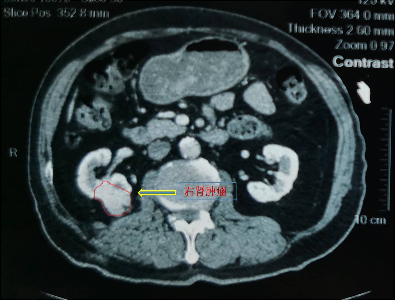 腹部增强ct证实:右侧肾脏术后改变,右肾下极直径约2cm肿物,考虑肾癌
