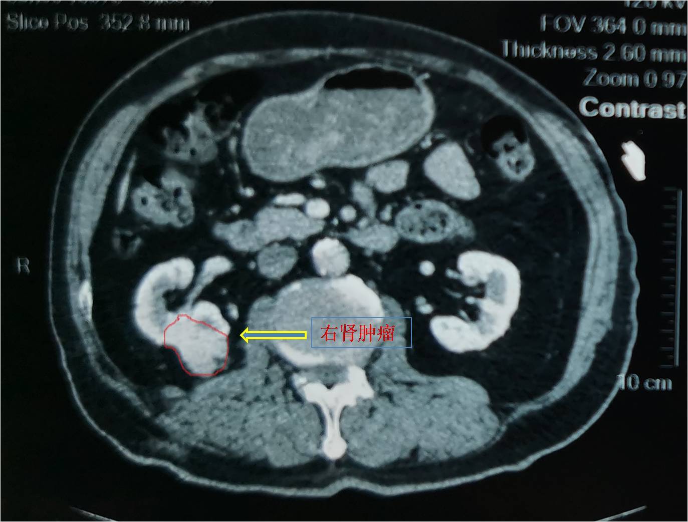 肾癌根治微创手术实例一之复发肾癌
