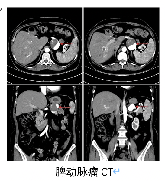 什么是脾动脉瘤?