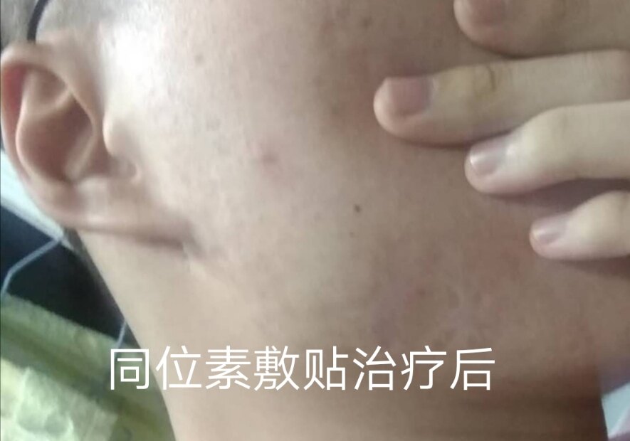 面部瘢痕疙瘩的同位素敷贴治疗需考虑美容需求