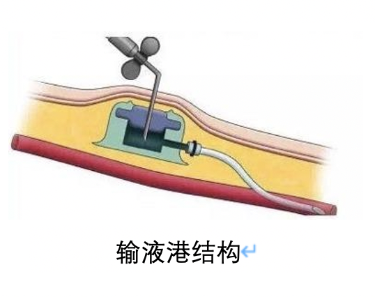 输液港藏在体内的输液神器
