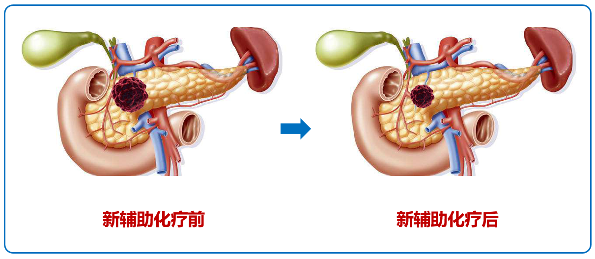 什么是胰腺癌的新辅助化疗