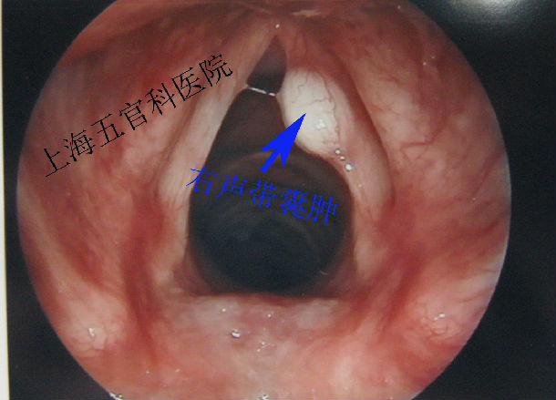 吴海涛 文章列表     声带囊肿 很常见,喉镜检查表现为声带表面或