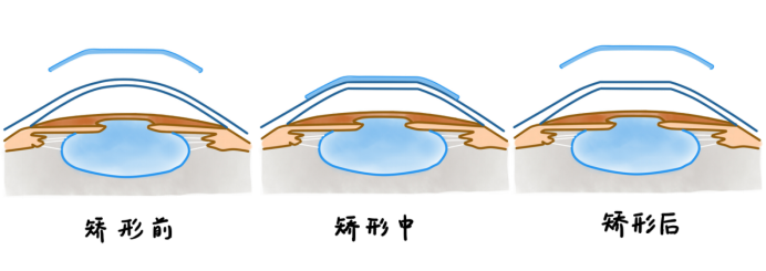 角膜塑形镜矫正近视的原理及其优缺点(一)