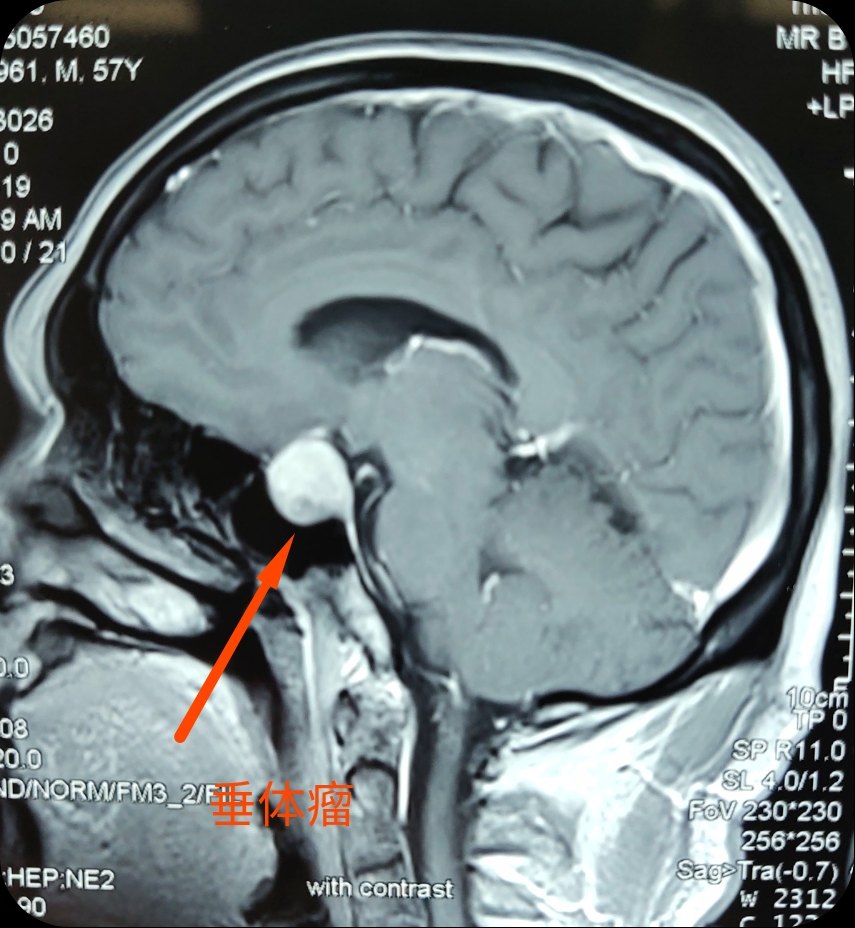 林伟教授讲述经神经内镜切除垂体瘤