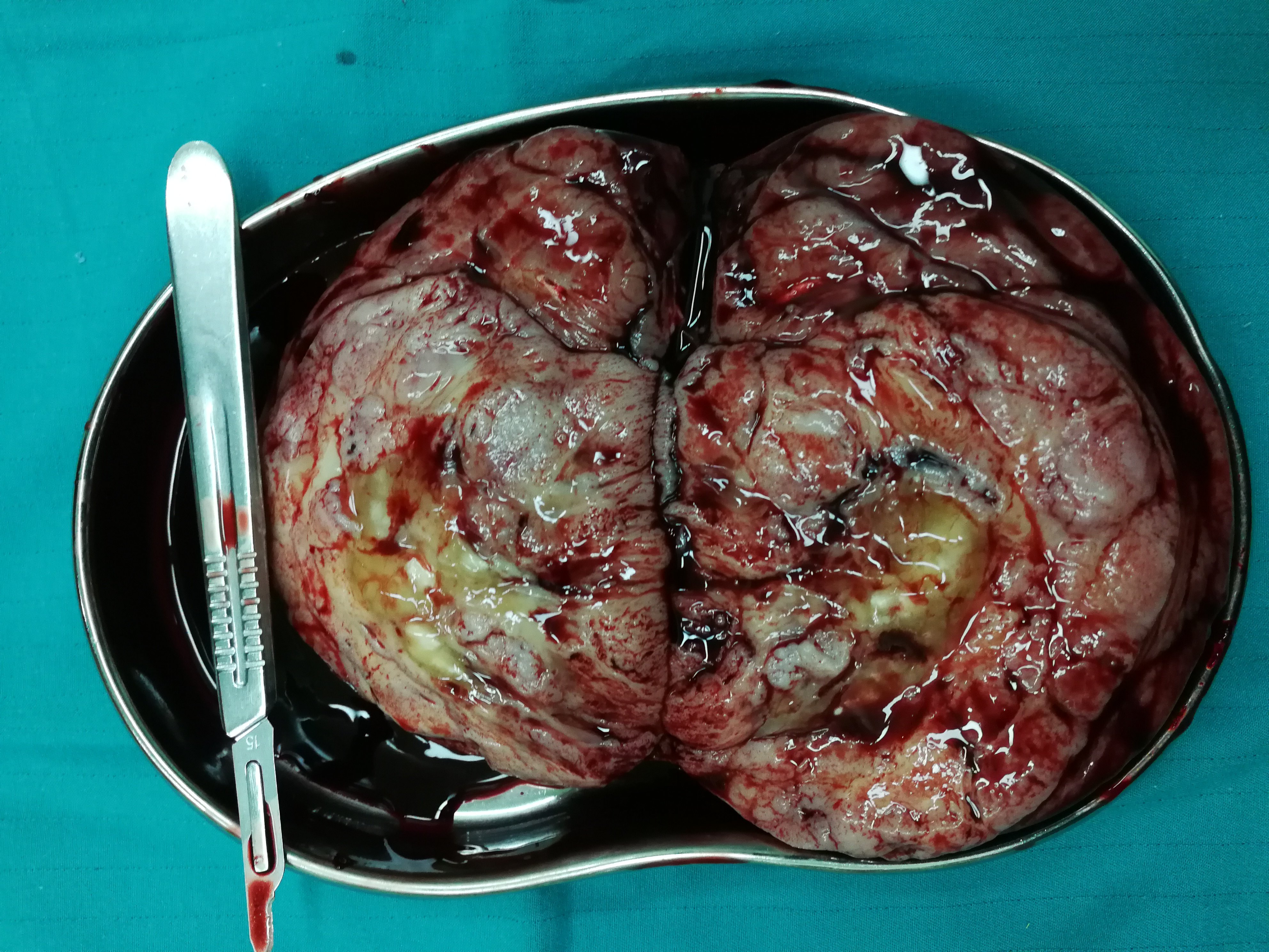 肾母细胞瘤 m.haodf.com