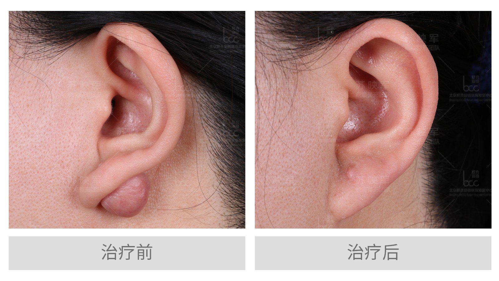 有疤痕疙瘩病史的患者,打耳洞时需谨慎,一定要注意下面几项