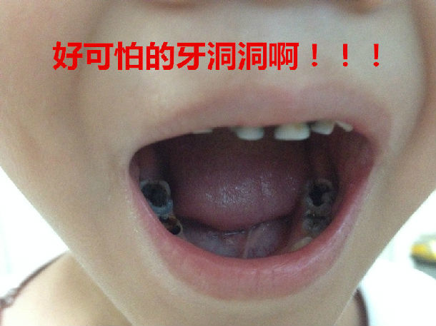 全国爱牙日说说龋齿预防的事
