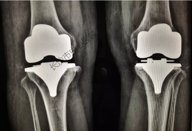双侧膝关节置换:治疗重度骨性关节炎