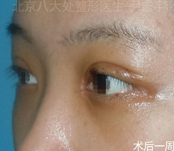 重睑 内眦开大 下睑睑袋切除术(经结膜入路)