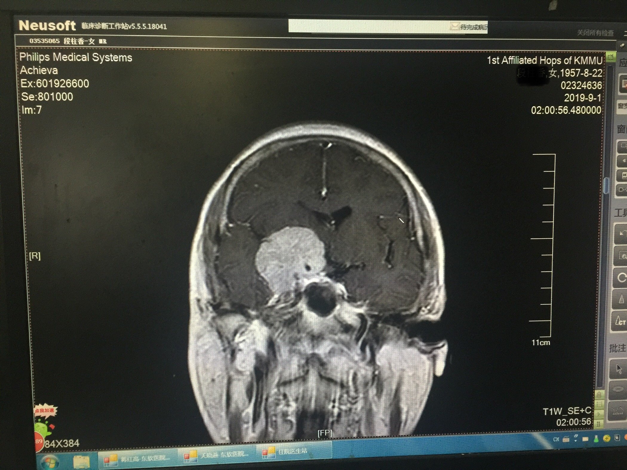 巨大蝶骨嵴脑膜瘤全切一例术前右眼视力严重下降术后视力恢复