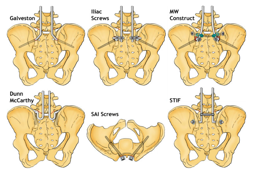 骶骨翼髂骨钉技术在腰骶椎内固定失效翻修中的应用