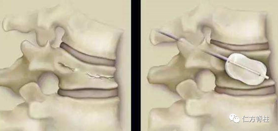 球囊扩张椎体后凸成形术pkp